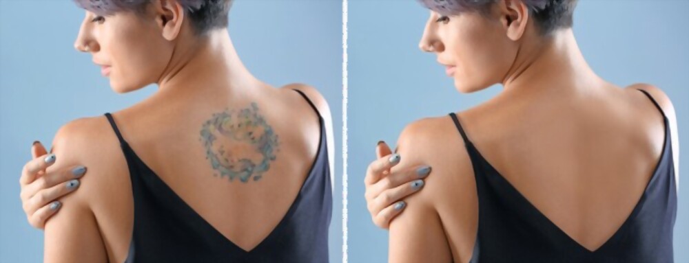 LASER TATTOO REMOVAL – ESTETICO